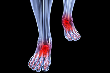 arthritic foot and ankle care treatment in the Wayne, NJ 07470, Paramus, NJ 07652, Clifton, NJ 07012, Montclair, NJ 07042, Randolph, NJ 07869 and Edison, NJ 08817 area