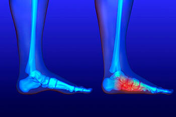 Flat feet and Fallen Arches treatment in the Wayne, NJ 07470, Paramus, NJ 07652, Clifton, NJ 07012, Montclair, NJ 07042, Randolph, NJ 07869 and Edison, NJ 08817 area