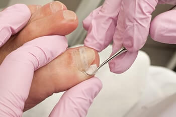 Ingrown toenails treatment in Wayne, NJ 07470, Paramus, NJ 07652, Clifton, NJ 07012, Montclair, NJ 07042, Randolph, NJ 07869 and Edison, NJ 08817 area