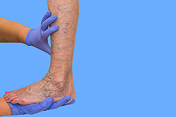 venous insufficiency