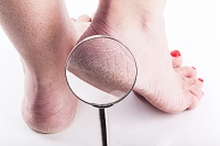 The Ugly Truth About Cracked Heels