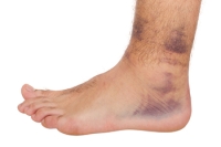 Facts About Sprained Ankles