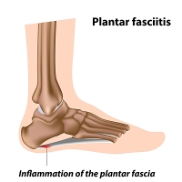 Healing the Pain of Plantar Fasciitis