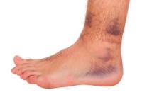 Causes and Treatment of a Sprained Ankle